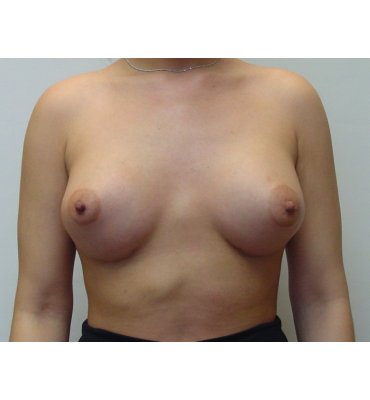 tuberous breast post